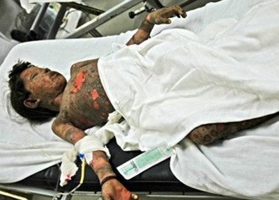 Child burnt by American bomb, Helmand, Afghanistan, 2007